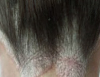 Psoriasis of the Scalp