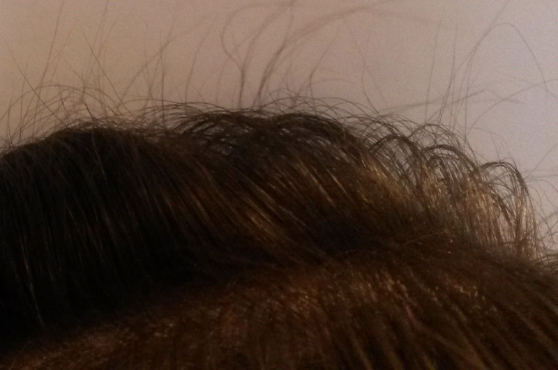 Female Diffused Telegon Hair loss