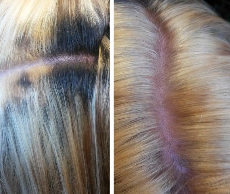 Scalp burn from Home Bleaching